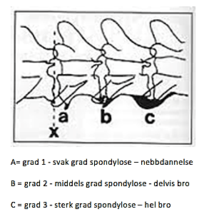 De tre gradene spondylose